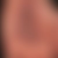 Arzneimittelreaktion, fixe: rezidivierender Verlauf mit akuter juckender Rötung 1 Tag nach Einnah...