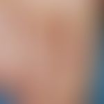 Bakterid Andrews, pustulöses. 53 Jahre alter Patient ohne ältere dermatologische Anamnese. Seit v...