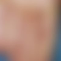 Bacteride Andrews, pustulous. 53-year-old patient without an older dermatological history. Pustul...