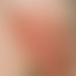 Bowen's disease:long-standing, slow-growing, sharply defined large-area, sometimes erosive, somet...