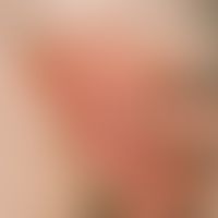 Bowen's disease:long-standing, slow-growing, sharply defined large-area, sometimes erosive, somet...