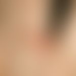 Bowen's disease: sharply defined plaque that has existed for 2 years, interspersed with scales, c...