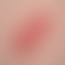 Bowen, M.. 22-year-old, 4 x 2 cm, slightly progressive, erythematous, scaly plaque on the back of...