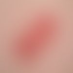 Bowen, M.. 22-year-old, 4 x 2 cm, slightly progressive, erythematous, scaly plaque on the back of...