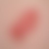 Bowen, M.. 22-year-old, 4 x 2 cm, slightly progressive, erythematous, scaly plaque on the back of...