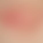 Bowen, M.: solitary plaque, progressive in size, occasionally accompanied by itching, measuring 1...