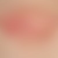 Bowen, M.: solitary plaque, progressive in size, occasionally accompanied by itching, measuring 1...