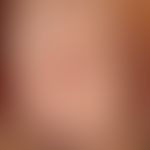 Bowen's disease: solitary, chronically dynamic, slowly and continuously growing for 14 months, as...