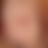 Bowen's disease: solitary, chronically dynamic, slowly and continuously growing for 14 months, as...