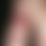 Bowen's disease: Chronically stationary, slowly increasing in area and thickness, sharply defined...