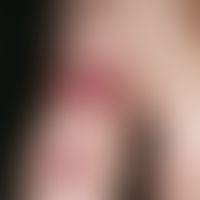 Bowen's disease: Chronically stationary, slowly increasing in area and thickness, sharply defined...