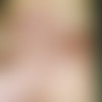 Candida-Granulom. Chronisch-rezidivierende, knotenartige, kutan-subkutan lokalisierte, tiefreiche...