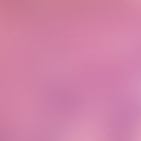 Candidose, chronisch-mukokutane (CMC). Ausgeprägte Akanthose mit parakeratotischer verhornung, sc...