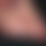 Candidose, chronisch-mukokutane (CMC). Entzündliche Rötung und gelblich-keratotische Plaques der ...