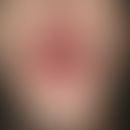 candidiasis, chronic mucocutaneous (CMC). pronounced doughy and persistent swelling of the lips w...