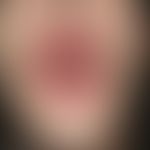 Candidose, chronisch-mukokutane (CMC). Ausgeprägte teigige und persistierende Schwellung der Lipp...