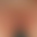 Candidosis intertriginous: Multiple, chronically dynamic, 0.2 cm large to large-area, blurred, re...