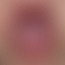 candidiasis of the oral mucosa
