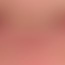 Cheilitis actinica chronica. Atrophisch veränderte Lippenhaut, erkennbar an der schleierartigen W...