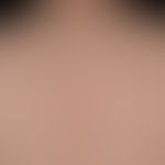 Akne, Steroid-Akne. Übersichtsaufnahme: Seit 4 Monaten persistierende, disseminierte, 1-4 mm groß...