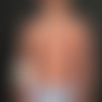 Pustulose, subcorneal. 6-year-old boy with infantile form of the disease. Craniocaudal erupted pu...