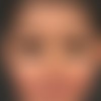 Pustulose, subcorneal. general view: Pronounced, fine-lamellar scaling on the scalp in a 6-year-o...