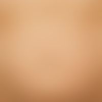 Desiccation dermatitis:  predominantly coarse lamellar desquamation of the altogether dry skin in...