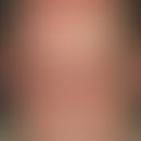 Dermatomyositis, Malignom-assoziierte. Livides Erythem periorbital (hier zusätzlich ödematös), pe...