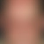 Dermatomyositis, Malignom-assoziierte. Livides Erythem periorbital (hier zusätzlich ödematös), pe...