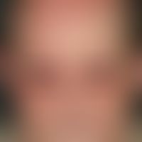 Dermatomyositis, Malignom-assoziierte. Livides Erythem periorbital (hier zusätzlich ödematös), pe...