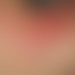 Dermatomyositis, Malignom-assoziierte. Livides, teils infiltriertes Erythem im Schultergürtelbere...