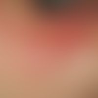 Dermatomyositis, Malignom-assoziierte. Livides, teils infiltriertes Erythem im Schultergürtelbere...