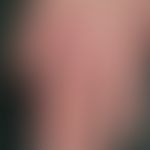 Dermatomyositis, Malignom-assoziierte. Streifig imponierende Erytheme im Bereich des distalen Han...