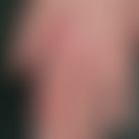 Dermatomyositis, Malignom-assoziierte. Streifig imponierende Erytheme im Bereich des distalen Han...
