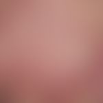Dermatomyositis, Malignom-assoziierte. Auftreten von ausgestanzt wirkenden Ulzerationen auf dem B...