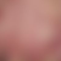 Dermatomyositis, Malignom-assoziierte. Auftreten von ausgestanzt wirkenden Ulzerationen auf dem B...