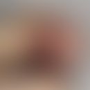 Angiosarkom, epitheloides. Zustand nach operativer Nagelentfernung zur Gewebeprobeentnahme. Unter...