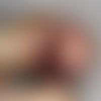 Angiosarkom, epitheloides. Zustand nach operativer Nagelentfernung zur Gewebeprobeentnahme. Unter...