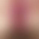 Dermatitis anale:&nbsp;uniforme, perianal lokalisierte, teils erosiv-nässende, unscharf begrenzte...
