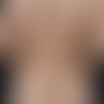 spot, lighter. smooth white spots in homogeneously tanned skin. 25-year-old female patient who de...