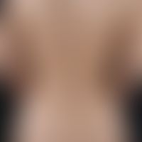 spot, lighter. smooth white spots in homogeneously tanned skin. 25-year-old female patient who de...