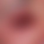 Toxic epidermal necrolysis: Infestation of the eyelids and surrounding area. Toxic epidermal necr...