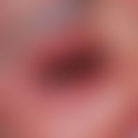 Toxische epidermale Nekrolyse. Befall der Augenlider und Umgebung. Toxische epidermale Nekrolyse ...