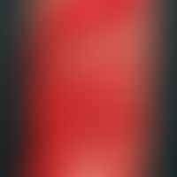 Toxic epidermal necrolysis. emergency hospitalization of a highly febrile (temp. 39.5 °C) 78-year...