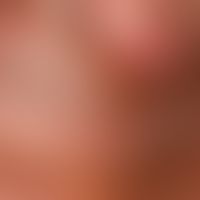 Toxische epidermale Nekrolyse. 2 Wochen nach Allopurinol Einnahme bei rezidivierenden Gichtanfäll...