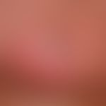 Toxic epidermal necrolysis. detailed view of a solitary, acutely occurring, perimamillary, sharpl...