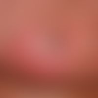 Toxische epidermale Nekrolyse. Detailaufnahme einer solitären, akut aufgetretenen, perimamillären...