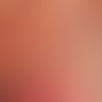 Toxic epidermal necrolysis. detailed picture: The 67-year-old female patient developed multiple, ...