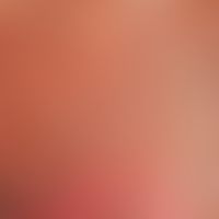 Toxische epidermale Nekrolyse. Detailaufnahme: Bei der 67 Jahre alten Patientin traten innerhalb ...