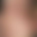 Urtica. 3-day recurrent, strong, transient wheals in the face of a 52-year-old man with acutely o...